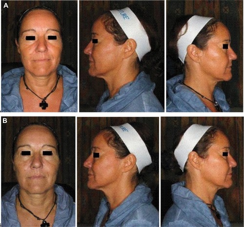 Figure 3 (A) Pre- and (B) immediate post-treatment photos after cheek augmentation and infraorbital hollow correction with 1.6 mL CaHA (cheek) and 0.2 mL hyaluronic acid (infraorbital hollow).