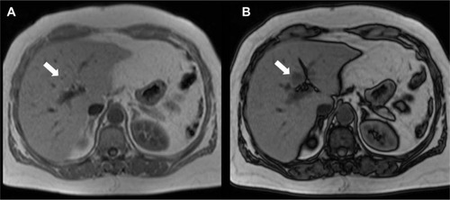 Figure 19 MRIs showing focal fat.