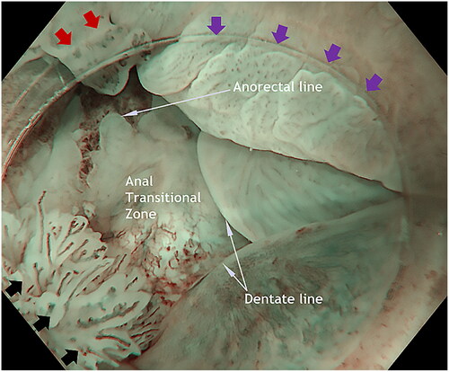 Figure 1. Landmarks in the anal canal seen under water: anorectal line, dentate line and the area between, the anal transitional zone. Purple arrowheads show a flat, slightly raised ASIL (anal squamous intraepithelial lesions) with widened and irregular IPCL (intra papillary capillary loops). Black arrowheads show an exophytic villous ASIL and the red arrowheads show an exophytic non-villous ASIL.