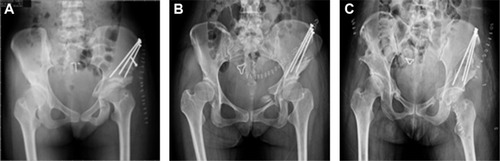 Figure 1 The AP view (left side) of postoperative radiographs for MSP (A), I-I (B), and TSP (C).