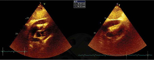 Figure 1. Transthoracic echocardiogram – subcostal window – showing a large circumferential pericardial effusion with right ventricular collapse