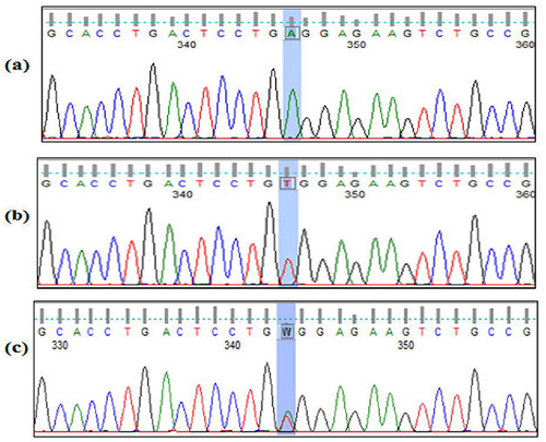 Figure 3 Partial chromatogram represents the normal (wild) and the mutant sequences of the beta-globin gene codon 6 (HbS). (a) shows the wild-type sequence. (b) shows the homozygous mutation (HBB):c.20A>T (p.Glu7Val). (c) shows the heterozygous mutation.
