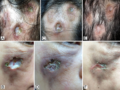 Figure 2 Cutaneous ulcers on the vertex and right cheek. (A and B) Prior to treatment. (C and D) After the application of modern wound dressing and topical antibiotic in the first month of follow up. (E and F) After the treatment with oral hydroxychloroquine in the third month of follow up.