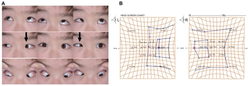 Figure 2 External photograph of the eyes, and Hess chart, at the initial examination. (A) Esotropia can be seen at the primary eye position. Abduction of the left eye is severely impaired, and adduction is mildly limited in both eyes (indicated by arrows). (B) Hess chart shows esotropia and limitation of abduction of the left eye.