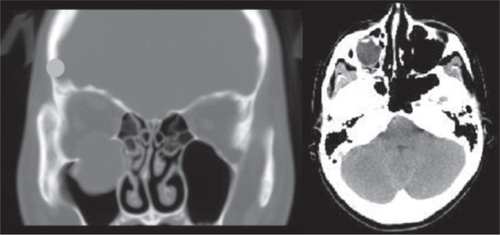 Figure 1 Computed tomographic images showing blow-out fracture of the lower right orbital wall. Left: Coronal section showing that the right eyeball is not perforated but has shifted downward into the maxillary sinus through the fracture of the lower orbital wall. right: Axial section showing that her right eyeball was displaced.