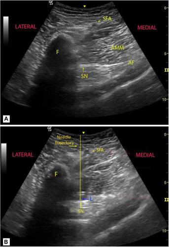 Figure 1 Ultrasound visualization of the proximal anterior sciatic block. (A) The ultrasound image obtained before needle placement. The curved array transducer is placed in the proximal third of the thigh medial to the femur at the level of the proximal adductor canal block. The sciatic nerve (SN) is well visualized 2–3 cm medial to the femur (F) and inferior to the adductor fascia (AF). Note the superficial femoral artery (SFA) which must be visualized prior to needle advancement. (AMM, adductor magnus muscle). (B) The ultrasound image immediately after local anesthetic injection. Note the local anesthetic (L) inferior to the adductor fascia. The needled trajectory is demonstrated. (Hashed line) The sciatic nerve (SN) is visualized within the local anesthetic and has moved inferiorly from the adductor fascia.