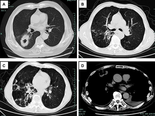 Figure 1 CT imaging of PN. Lung CT images of PN had no specificity and could be presented as: (A) lobe consolidation with bronchial inflata signs and cavities; (B) tree-in-bud and small cavities; (C) bronchiectasis, patch shadow, small nodules; (D) cavity and pleural effusion.