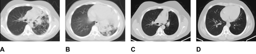 Figure 1 Chest computed tomography (CT) scan before and after anti-tuberculosis treatment and interventional treatment. (A and B) Segmental infiltration and consolidation in the left lung and apparent stenosis of the left main bronchus before treatment, (C and D) Improvement of left bronchus stenosis and infiltration absorption observed after therapy.