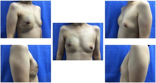 Figure 2 Right breast cancer with nipple-sparing mastectomy and direct implant reconstruction: postoperative view at 3 months.