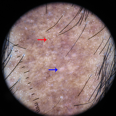 Figure 4 Trichoscopy of lichen planopilaris shows fibrotic white dots (blue arrow) and pinpoint white dots (red arrow).