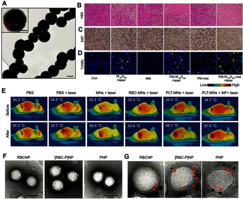 Figure 8 (A) Representative TEM image of negatively uranyl acetate-stained PLT-MNs.Citation79 (B) Representative H&E staining of tumor tissues in tumor-bearing mice with different treatments. Scale bar =50 μm. (C) Images of Ki67 immunohistochemical staining in tumor tissues harvested from the mice in accordance with (B). Scale bar =50 μm. (D) TUNEL staining images of tumor sections from tumor-bearing mice after different treatments. The color blue is nuclei stained by DAPI. Scale bar =20 μm. (E) Representative in vivo IR thermal images of tumor-bearing mice before and after different combinations of treatments. (F) Representative TEM images of RBCNPs, [RBC-P]NPs, and PNPs, negatively stained with vanadium (scale bar =100 nm). (G) Immunogold TEM images of RBCNP, [RBC-P]NP, and PNP samples probed for CD235a (red arrows, large gold) and CD61 (orange arrows, small gold), followed by negative staining with vanadium (scale bars =50 nm). Copyright ©2017. John Wiley and Sons. Reproduced from Rao L, Bu -L-L, Meng Q-F, et al.Antitumor platelet-mimicking magnetic nanoparticles. Adv Funct Mater. 2017;27:9.79.Citation79 Reprinted from Acta Biomaterialia, 80, Zuo H, Tao J, Shi H, He J, Zhou Z, Zhang C. Platelet-mimicking nanoparticles co-loaded with W18O49 and metformin alleviate tumor hypoxia for enhanced photodynamic therapy and photothermal therapy. 296–307, Copyright (2018), with permission from Elsevier.Citation80 Copyright ©2017. John Wiley and Sons. Reproduced from Dehaini D, Wei X, Fang RH, et al.Erythrocyte-platelet hybrid membrane coating for enhanced nanoparticle functionalization. Adv Mater. 2017;29(16):1606209. doi:10.1002/adma.201700681.Citation82Notes: Fig 8 parts A, E is taken from reference 79, parts B-D is taken from reference 80, parts F,G is taken from reference 82.Abbreviations: PLT-MNs, PLT membrane-coated particles; [RBC-P]NPs, RBC–platelet hybrid membrane-coated nanoparticles; PNPs, platelet membrane-coated nanoparticles.