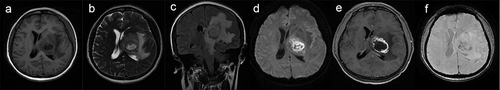 Figure 1 Brain magnetic resonance imaging of patient 1. Brain magnetic resonance imaging showed lesions in the left basal ganglia area with edema and midline shift (a–c). Restricted diffusion in the necrotic component on diffusion-weighted images (d), ring enhancing lesion on contrast-enhanced images (e), and mixed low signal in the necrotic component on susceptibility-weighted images (f).