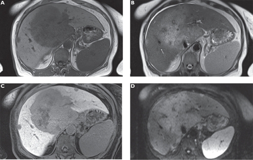 Figure 5 Cholangiocellular carcinoma. Plain T1-weighted spoiled 2D gradient echo (GRE) A) T2-weighted half-Fourier acquisition single-shot turbo spin-echo (HASTE) B) hepatocellular phase gadoxetic acid-enhanced fat-suppressed (FS) T1-weighted spoiled 3D GRE C) and diffusion-weighted imaging (DWI) D) in the axial plane. A large central liver mass is demonstrated on unenhanced sequences. Gadoxetic acid-enhanced magnetic resonance imaging (MRI) shows the lesion much better and additional satellite lesions in both liver lobes with increased conspicuity.