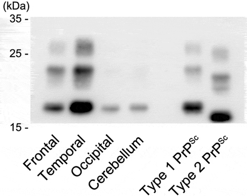 Figure 5. Western blot analysis of proteinase K-resistant prion protein (PrP). The gel mobility of PrPSc from the present patient was compared with that of other patients with methionine/methionine type 1 (MM1)-type and MM2-type sporadic Creutzfeldt-Jakob disease (sCJD). PrPSc migrated as three bands, which correspond to the diglycosylated (upper band), monoglycosylated (middle band), and unglycosylated (lower band) forms. The unglycosylated bands appear at approximately 21 kDa in the present case (frontal, temporal, and occipital cortices and cerebellar cortex). The findings indicate type 1 PrPSc. The MM2-type and MM1-type sCJD controls (the right lane and the next lane) show type 2 PrPSc located at 19 kDa and type 1 PrPSc located at 21 kDa, respectively