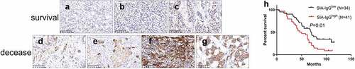 Figure 1. The expression of SIA-IgG is correlated with clinical prognosis in breast cancer. Immunohistochemistry staining for SIA-IgG in breast cancer tissues. For example, infiltrating ductal carcinoma showed weak SIA-IgG-positive staining in the tissues of surviving patients (a, b, and c) and strong SIA-IgG-positive staining in the tissues of deceased patients (d, e, f, and g) with invasive breast cancer. The clinical characteristics of the tissues are as follows: (a) well differentiated (grade I), without lymph node metastasis, TNM stage IIA. (b) moderately differentiated (grade I), without lymph node metastasis, TNM stage IIB. (c) moderately differentiated (grade II), with lymph node metastasis (TNM-N1), TNM stage IIIA. (d) moderately differentiated (grade II), with lymph node metastasis (TNM-N2), TNM stage IIA. (e) moderately differentiated (grade II), without lymph node metastasis, TNM stage IIB. (f) moderately differentiated (grade II), with lymph node metastasis (TNM-N1), TNM stage IIIA. (g) moderately differentiated (grade II), with lymph node metastasis (TNM-N1), TNM stage IIIB. (h) Kaplan–Meier survival for SIA-IgG high expression and low expression groups. Patients in the SIA-IgG high expression group (SIA-IgGhigh, staining score ≥ 150) had a significantly poorer prognosis than those in the SIA-IgG low expression (SIA-IgGlow, staining score < 150) group (P = 0.01).