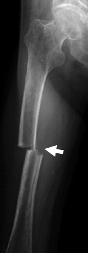 Figure 3. Case 2. Right transverse diaphyseal fracture with a medial spike (arrow).