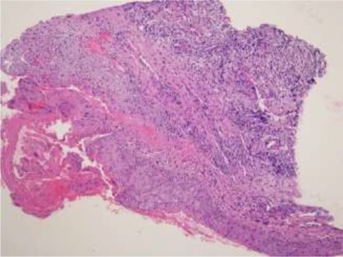 Figure 3 A scleral tissue biopsy showing mucosal erosion and submucosal fibrosis with necrobiosis of collagen and sheets of mononucleated foamy histiocytes (xanthoma cells), infiltrating the submucosal fibrous tissue, accompanied by variable numbers of dispersed lymphocytes and plasma cells (hematoxylin-eosin; original magnification: ×40).