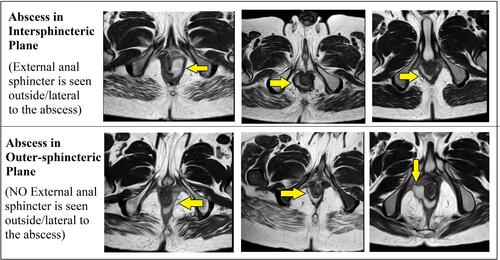 Figure 2 Upper panel: Abscess in the intersphincteric space (external sphincter muscle can be seen lateral to the abscess). Lower panel: Abscess in the outer-sphincteric space (external sphincter muscle cannot be seen lateral to the abscess and the abscess is juxtaposed to the fat in ischiorectal fossa).