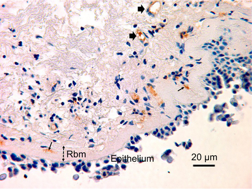 Figure S1 VEGF-stained vessels in the Rbm and LP are pointed out with narrow arrows and wide arrows, respectively.Notes: The lamina propria is situated beneath the Rbm. The width of the Rbm is shown by a two-headed arrow. Magnification ×400.Abbreviations: Rbm, reticular basement membrane; LP, lamina propria.