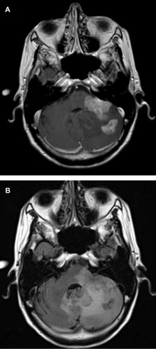 Figure 1 (A) Axial T1-weighted postgadolinium contrast-enhanced magnetic resonance image of a 53-year-old patient with a progressive multifocal glioblastoma revealing two lesions: one in the left cerebellar hemisphere and the other extending into the cerebellar peduncle and infiltrating the brainstem. Both the lesions have uniform contrast enhancement, along with ill-defined irregular margins. (B) Axial fluid attenuated inversion recovery images reveal a more diffuse hyperintense lesion infiltrating into the adjacent cerebellum and brainstem. The hyperintense signal crosses the midline vermis and involves the contralateral cerebellar hemisphere as well.