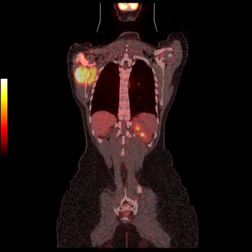 Figure 1 PET scan showing unifocal bone involvement of the scapula with mass.