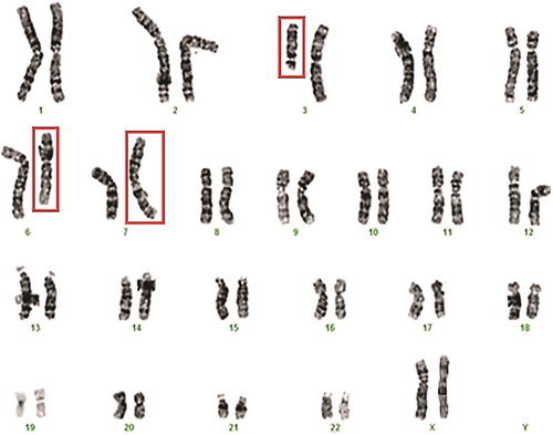 Figure 1. Karyotype of the female patient showing the three-way exchange involving chromosomes 3, 6 and 7 in Case I: 46, XХ,t(3;6;7)(3pter→3q13.2::7p22→7pter;6pter→6q21::3q13.2→3qter;7qter→7p22::6q21→6qter).
