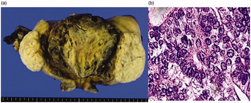 Figure 4. (a) Macroscopic findings of a specimen. Coagulation necrosis due to thermal denaturation of the endometrium and the myometrium is seen. (b) Histopathological image of the endometrium after MEA (HE staining X40). Coagulation necrosis due to thermal denaturation of the endometrium and the myometrium is seen, but with some remnant endometrial adenocarcinoma. MEA: microwave endometrial ablation; HE: hematoxylin-eosin.