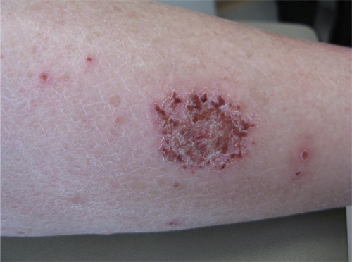 Figure 4 Nummular eczema.