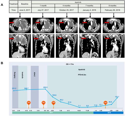 Figure 2 Contrast-enhanced CT images and serum CA125 level changes throughout the apatinib therapy. (A). CT images reveal that the mass grew quickly until apatinib treatment was given. After apatinib treatment, the mass was observably decreases in size one month later and continues to shrink at a follow-up period of 4 months (October 25, 2017); however, the mass increases in size 7 months later (January 4, 2018), liver and pancreas metastasis are detected 8 months later (February 26 2018). (B). Serum CA125 levels continuously increase from 231.3 U/mL (February 21, 2017) to 252.3 U/mL (June 6, 2017) until apatinib treatment is given. After apatinib treatment begins in June 8, 2017, at a follow-up period of one month, serum CA125 levels significantly decrease to 150.8 U/mL (July 27, 2017). Then, apatinib is used as maintenance therapy, and CA125 dramatically decreases to a minimum of 7.1 U/mL (October 25, 2017). Finally, the evaluation indicates PD and the patient’s CA125 increases to 132.7 U/mL again in May 25, 2018.