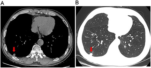 Figure 1. Chest computed tomography (CT) scans. CT images of the lung window (A) and soft tissue window (B) revealed a 1.4 × 1.3 × 1.1 cm solitary solid nodule in the left lower lobe (arrowhead), mild ground-glass opacity and multiple small nodules in both lungs.