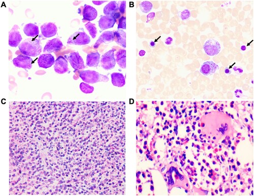 Figure 1. Morphologic features of BM sample from the patient. (A) BM aspiration smear on admission in February 2020 revealed abnormal accumulations of immature cells containing multiple Auer rods in the cytoplasm (arrow) (100×). (B) BM aspiration smear in November 2020 after APL CR revealed erythroid cells were significantly increased, mainly composed of middle and late juvenile erythrocytes. (arrow) (100×). (C) BM biopsy on admission in February 2020 showing hypercellularity of immature atypical myeloid cells (H&E-stained image, 40×). (D) BM biopsy in November 2020 after APL CR. H&E-stained sections show active hyperplasia of nucleated myeloid and erythroid cells. The morphology of those cells was generally normal (40×).