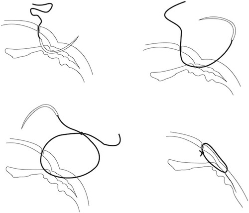 Figure 3 Schematic drawing of indirect cyclopexy technique.