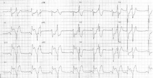 Figure 1 The patient’s electrocardiogram on presentation.