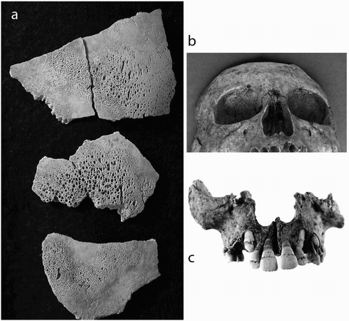 Figure 4. Examples of childhood physiological stress markers. (a) Porotic hyperostosis of the cranial vault in burial V10, a 6-month-old child from Medieval Wharram Percy, England (photographs by Simon Mays), (b) Cribra orbitalia in SK 225, a 7–10-year-old child, from Medieval Ballyhanna, Co. Donegal, Ireland (photograph by Jonathan Hession). (c) Linear dental enamel hypoplasia in the permanent dentition of SK 251, a 9–11-year-old Medieval child, from Armoy, Co. Antrim, N. Ireland (photograph by Tony Corey).