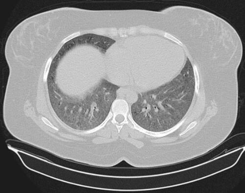 Figure 4 HRCT of chest showing centrilobular nodules.