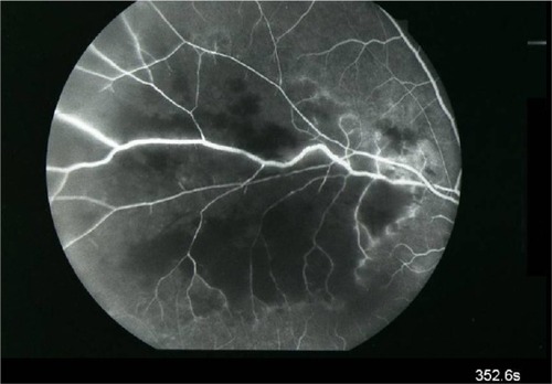 Figure 4 A capillary non-perfusion in the circulation of the supratemporal vein was also noticed.