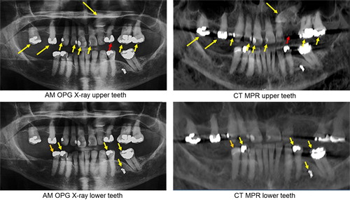 Figure 5. Comparison between antemortem (AM) orthopantomogram (OPG) X-ray of a missing person and multiplanar reconstructions (MPR) of CT data of the upper and lower jaws of a victim. Corresponding features are indicated by yellow arrows. The red arrow in the upper jaw indicates a tooth that was extracted before death and the orange arrow in the lower jaw indicates a filling that was replaced. Both are accounted for in the written dental record. (Image courtesy Health Support Queensland Forensic and Scientific Services (HSQ FSS) and the Queensland State Coroner, with permission).