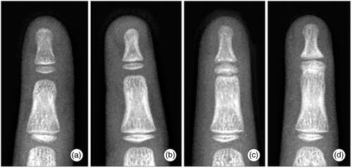Figure 4. Grades of symphalangism: (A) Normal joint. (B) Grade I: fibrous symphalangism – mild joint space narrowing in distal interphalangeal joint. (C) Grade II: cartilaginous symphalangism – minimal joint space is observed. (D) Grade III: bony symphalangism. (reprinted from Baek, Lee [Baek 8]: https://www.ecios.org/DOIx.php?id=10.4055/cios.2012.4.1.58) under the Creative Commons Attribution Non-Commercial License: https://creativecommons.org/licenses/by-nc/3.0/)