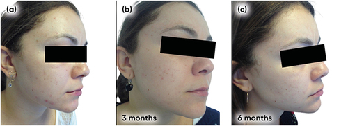 Figure 2 Case study 1 improvement on right-hand side of face, baseline to 6 months (a) Baseline (b) 3 months with AZA 15% gel twice daily (c) 6 months with AZA 15% gel twice daily.