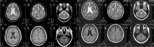 Fig. 4 Two repeated brain MRIs revealed no new changes. A, B, C, D, E and F were scanned in September 2010. G, H, I, J, K and L were scanned in December 2013.