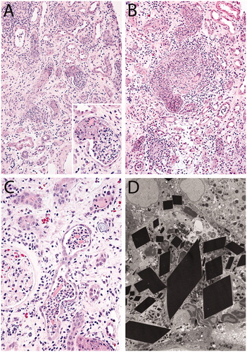 Figure 1. (A) Tubules showing extensive neutrophil inflammation with eosinophilic crystals (A. 20× [inset 60×], H&E). (B) Granulomatous response to tubular rupture (20×, H&E). (C) Rhomboid and needle shaped intraluminal crystals (40×, H&E). (D) Ultrastructurally, there were needle shaped and rhomboid intraluminal hyperdense crystalline structures (×4000).