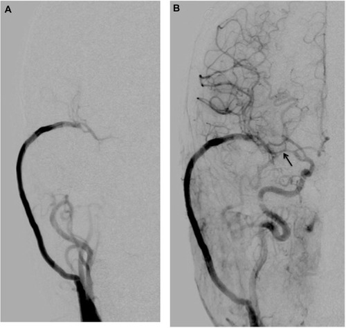 Figure 3 Postoperative right carotid angiogram performed 7 days after surgery demonstrates that (A) the ipsilateral middle cerebral artery (MCA) area is supplied by the patent high-flow bypass during the arterial early phase of angiography; and (B) resolution of the blood blister-like aneurysm and no stenosis in the affected intracranial internal carotid artery (ICA), however, moderate narrowing (arrow) of the proximal segment in the MCA. During the arterial late phase, anterograde filling via the ICA is shown (B).