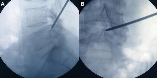 Figure 1 Sagittal (A) and anteroposterior (B) fluoroscopic images of the Tom Shidi.