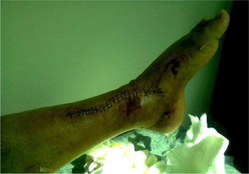Fig. 4 Initial presentation of the skin lesion after the internal fixation of the pilon fracture.