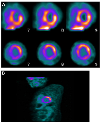 Figure 3 PET images of a patient with CS.