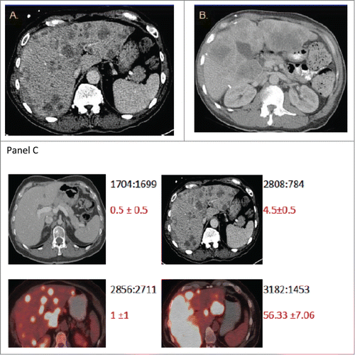 Figure 2. The burden of metastatic disease in the liver does not correlate with CTC count as determined by the CellSearch method. Shown are CT scans of the abdomen from 2 patients (A and B) with diffuse colorectal cancer with hepatic metastases and high baseline CTC numbers. CT scans were performed before initiation of chemotherapy (baseline). The scans in panel C provide illustrative examples of the observed inter-patient heterogeneity from 4 patients. The numbers in black depict the ratio of total liver volume: volume of disease free liver, and the numbers in red depict the mean CTC count from replicates +/− standard error of the mean.