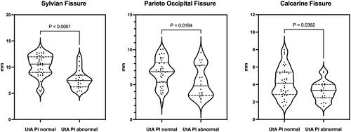 Figure 2. Violin plots showing distribution of Sylvian fissure, parieto occipital fissure and calcarine in growth restricted (FGR) fetuses with normal or abnormal uterine artery (UtA PI). Circles represent individual points, horizontal lines indicate median (continuous), and interquartile range (IQR) (dotted). Comparison among groups was performed by Mann–Whitney U test.