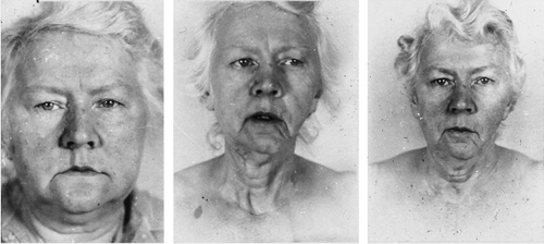 Figure 1.  A 58 year old woman with metastatic thyroid cancer. Euthyroid (left panel), hyperthyroid due to functioning mediastinal metastases (middle panel), and euthyroid after thyroidectomy and 131I treatment and on thyroid hormone substitution (right panel).