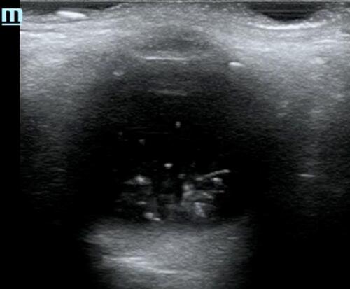Figure 6 Ocular ultrasound example of a vitreous hemorrhage.