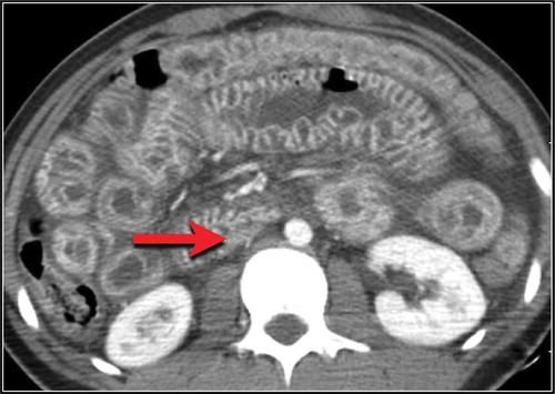 Figure 1. CT scan.Bowel wall thickening at the level of distal descending and sigmoid colon indicated by a red arrow – CT scan.